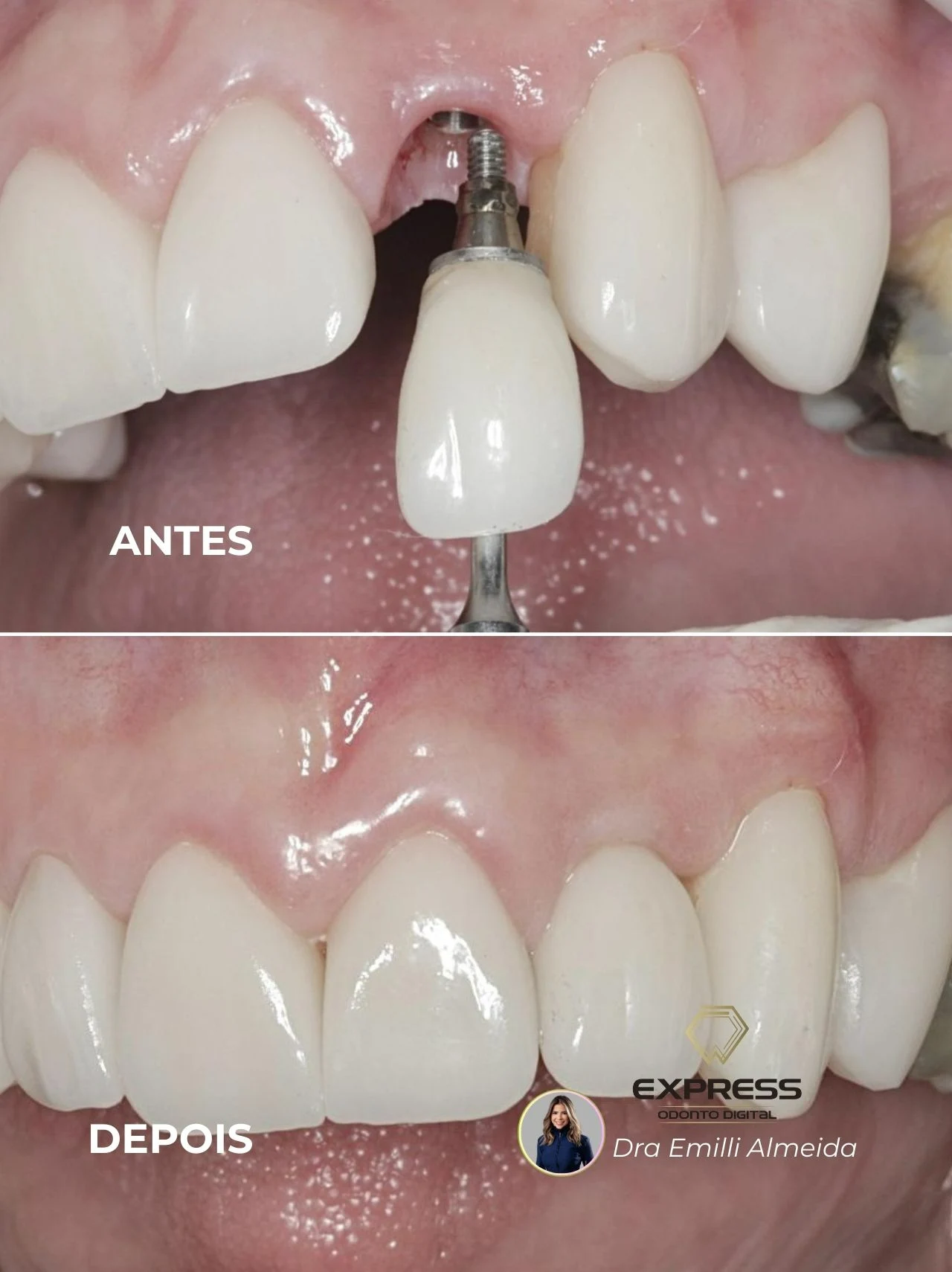 Implante Dentário Itabuna Com Dra Emilli Almeida Odonto Express Antes Depois