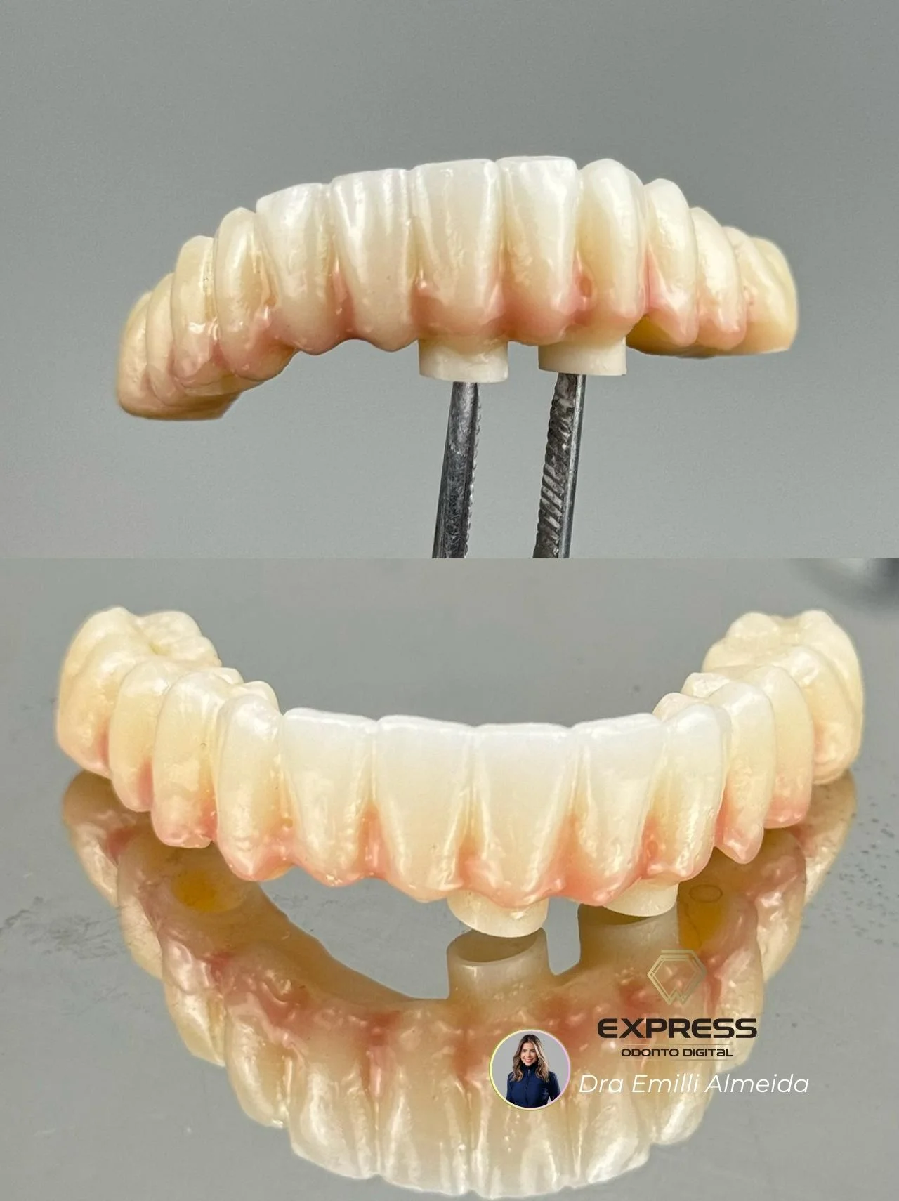 Prótese Protocolo de Zircônia Odonto Express Itabuna Dra Emilli Almeida